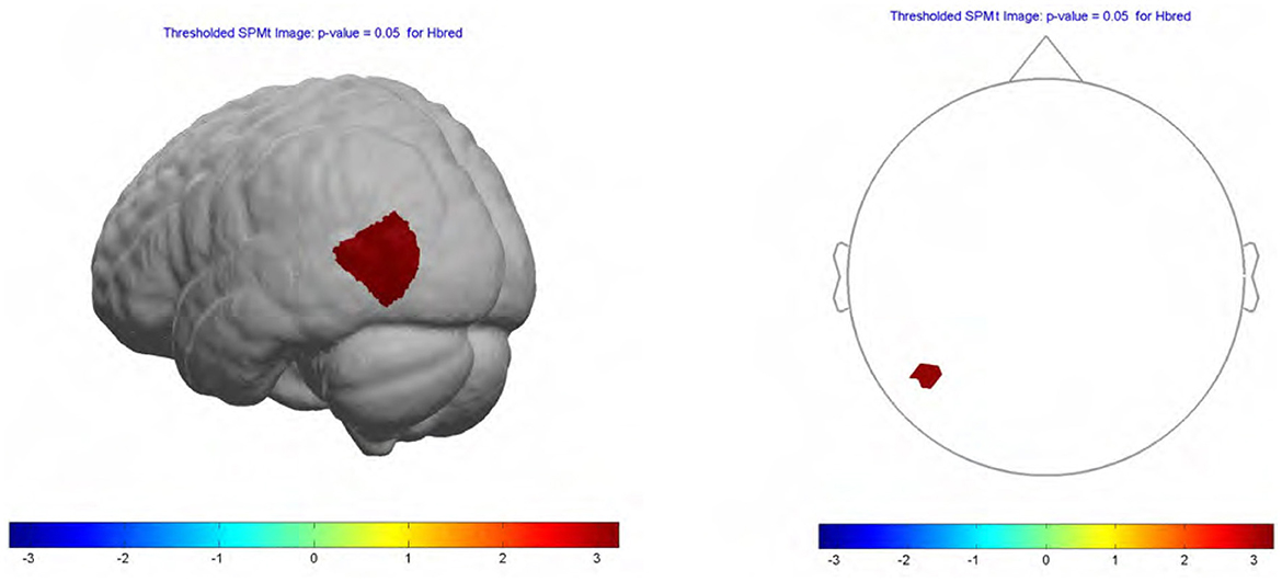 3D brain model highlighting a red area on the left side, with a corresponding 2D top-down image on the right showing the same red area. Both visuals include a color scale from blue to red indicating data range from negative three to three, with a p-value threshold of 0.05.