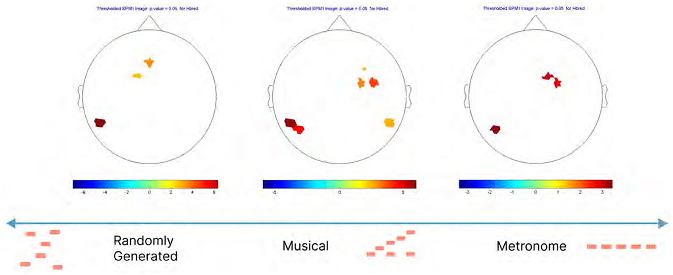 Three brain activity maps titled “Thresholded SPMt Image: p-value = 0.05 for Hbred” show differences in activity under three conditions: Randomly Generated, Musical, and Metronome. The maps display colored regions indicating varying activity levels, with color bars underneath showing scales from negative to positive. The bottom section illustrates temporal event patterns for each condition with red and orange dashes on a blue arrow.