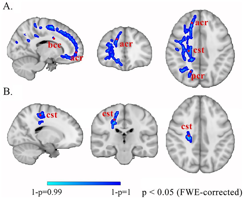 Brain scan images divided into two sections, A and B, displaying regions marked in blue. In section A, annotated areas include