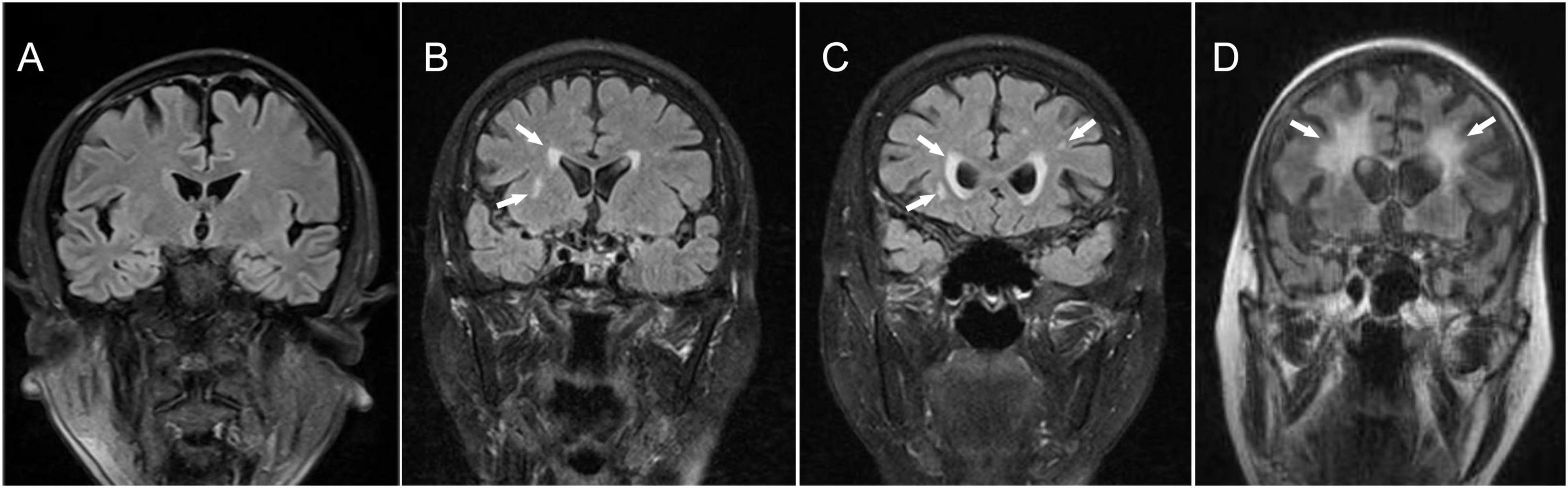 MRI scans of the brain showing coronal slices labeled A to D. Image A displays a baseline scan. Images B, C, and D show lesions indicated by white arrows, suggesting pathological changes, possibly inflammation or lesions in the brain tissue.