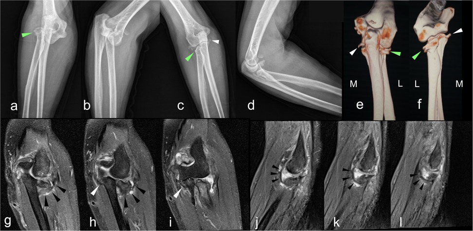 Composite image showing various views of an elbow joint, including X-rays, 3D renderings, and MRI scans. Panels a to d depict elbow X-rays with specific areas highlighted by arrows. Panels e and f present 3D models of the elbow joint with marked regions. Panels h to m display MRI scans highlighting different structural aspects of the elbow. Each panel focuses on specific anatomical features or abnormalities, indicated by arrows.