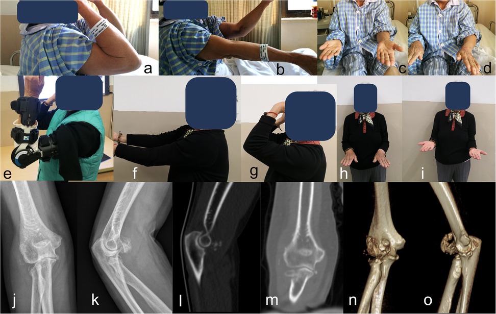 A series of images showing individuals with varied arm positions and medical imaging of an elbow. Top row: people in different arm postures, including flexion, extension, and rotation (a-i). Middle and bottom row: X-rays and CT scans displaying elbow joint details (j-o).