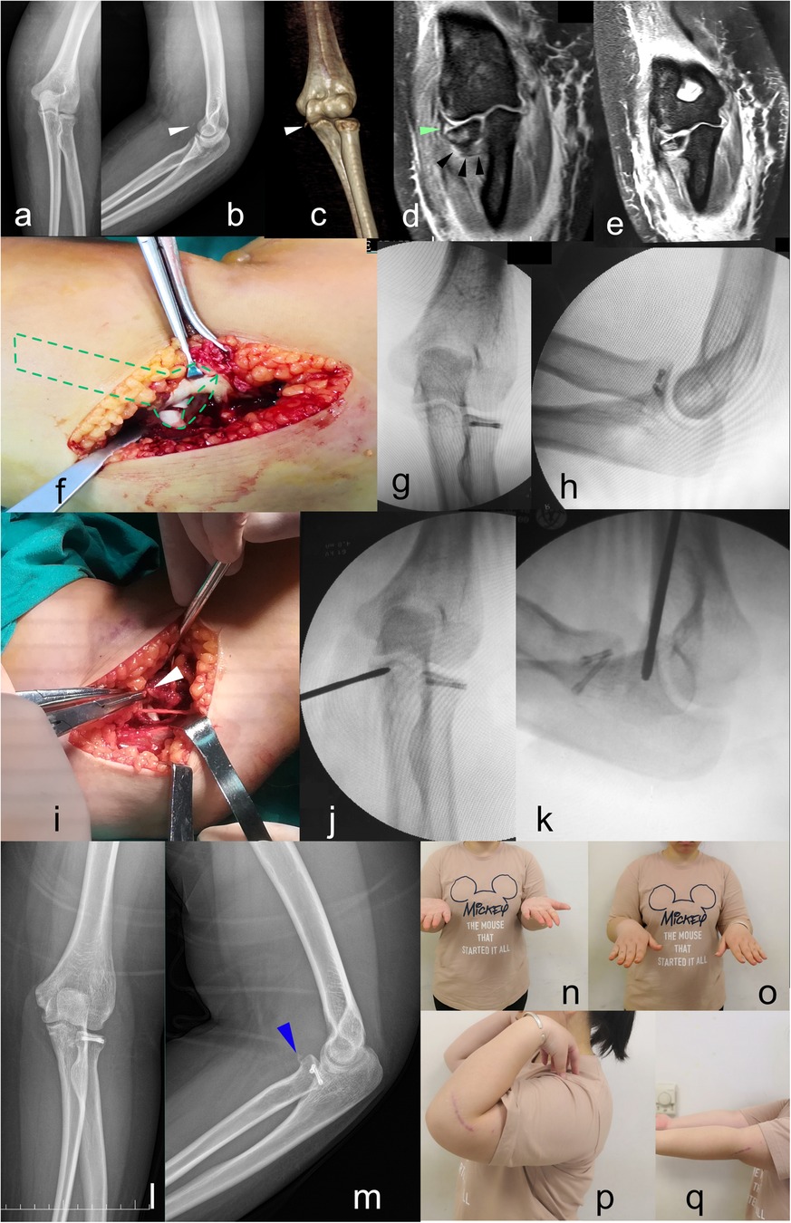 A series of images showing medical and surgical procedures related to the elbow, including X-rays, MRIs, surgical incisions, and post-operative outcomes. Panels a to m include various images of the elbow at different stages of treatment, with arrows highlighting points of interest such as fractures, surgical tools, and post-surgery stabilization. Panels n to q depict a person performing arm movements and showing a surgical scar, indicating post-operative range of motion.