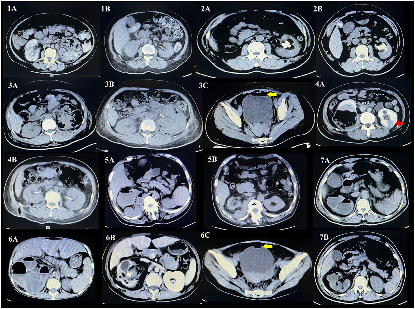 A series of abdominal and pelvic radiological images, including X-rays and CT scans, showing various views of the skeletal structure and internal organs. The images display differences in angles and sections, with some containing visible medical tubing or catheters. Each image is labeled, suggesting multiple analysis at different stages or conditions.