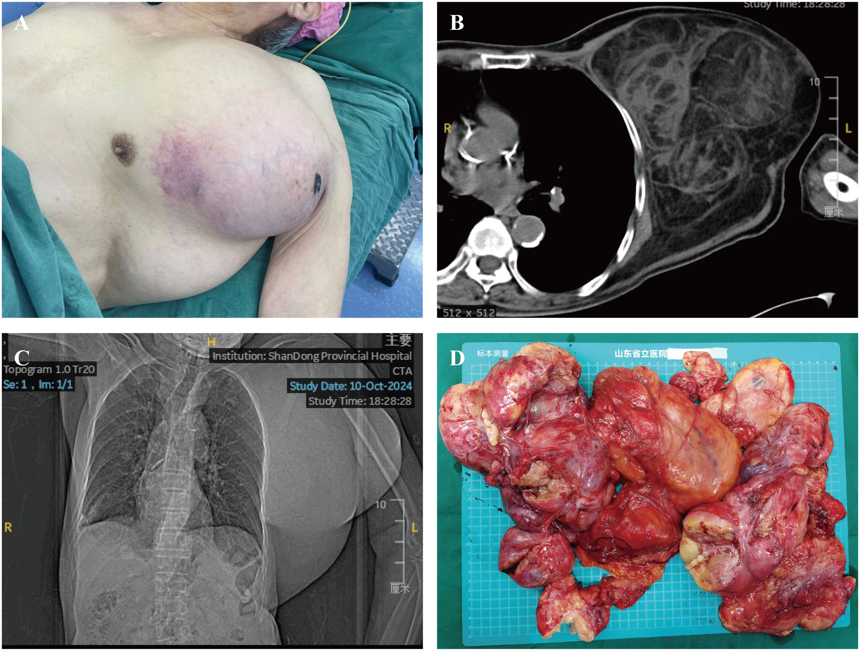 A series of medical images illustrating a large chest tumor. Image A shows a patient's torso with a prominent swelling on the chest. Image B is a CT scan displaying the tumor in cross-section, showing its internal structure. Image C offers a topogram, presenting an X-ray view of the patient's chest and tumor. Image D depicts the excised tumor, displaying a large, irregular, reddish mass on a surgical tray.