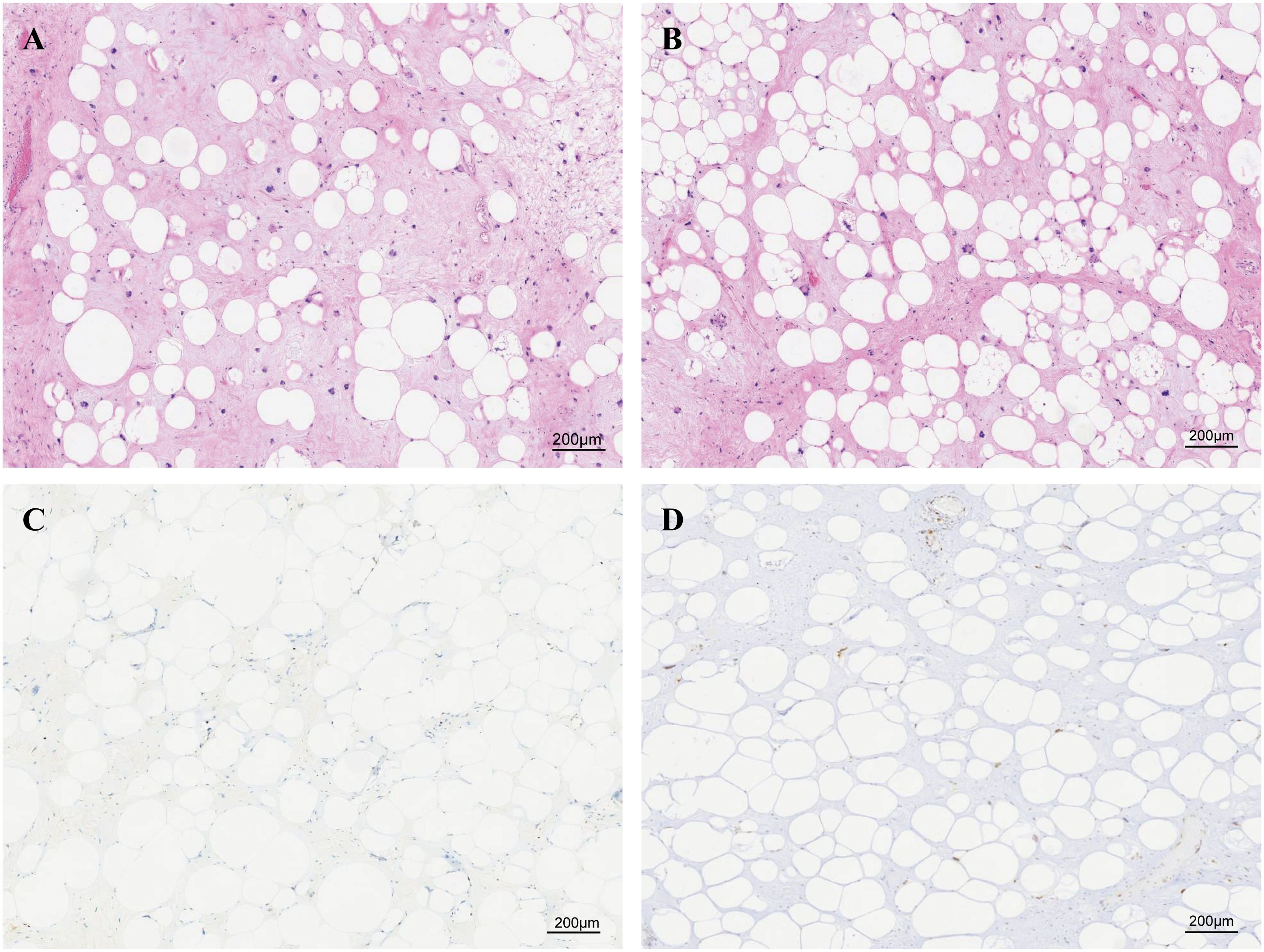 Microscopic images in four panels (A, B, C, D) show tissues with various degrees of adipocytes, marked by large white circular structures. Panels A and B display pink-stained tissues, indicating the presence of extracellular matrix components, while Panels C and D show lighter staining, focusing on the adipocytes. Each panel measures 200 micrometers.