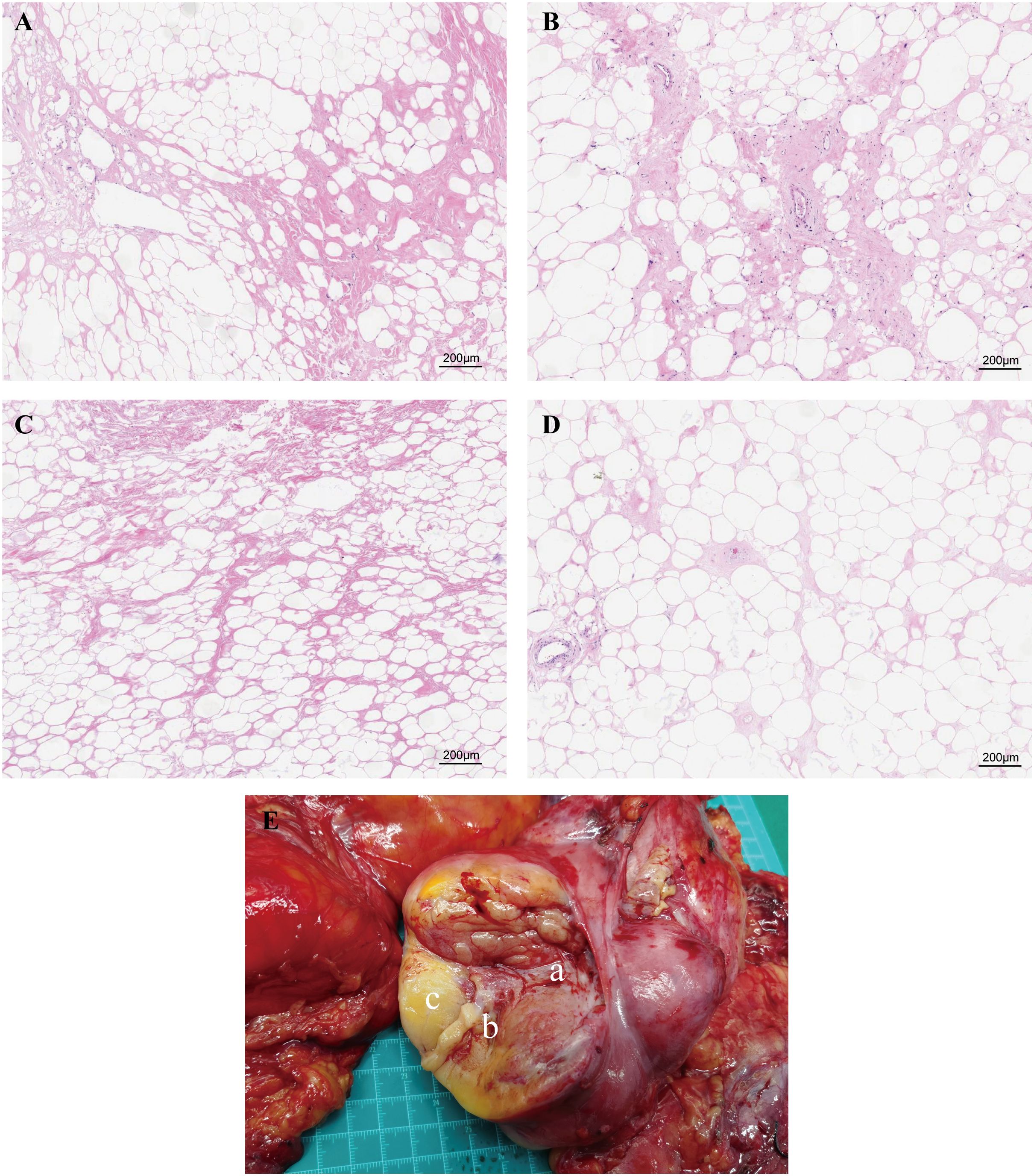 Panel A, B, C, and D show histological images of tissue with clusters of cells and varying degrees of fibrous and adipose content, stained in shades of pink and white. Panel E depicts a dissected tissue mass with distinct sections labeled a, b, and c, showing varied colors and textures, including red, yellow, and pink areas, placed on a blue grid background.