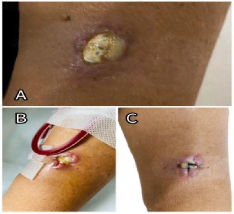 Images (A–C) depict three medical conditions on the skin. (A) Shows a raised lesion with a pus-like center. (B) Shows a similar lesion with medical tubing and tape nearby. (C) Shows a healing lesion with visible stitches.