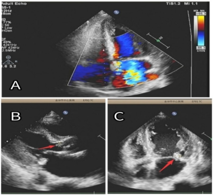 Three ultrasound images labeled (A–C). Image (A) shows a color Doppler scan with blue and red areas indicating blood flow. Image (B) and Image (C) highlight specific regions with red arrows, focusing on different anatomical structures.