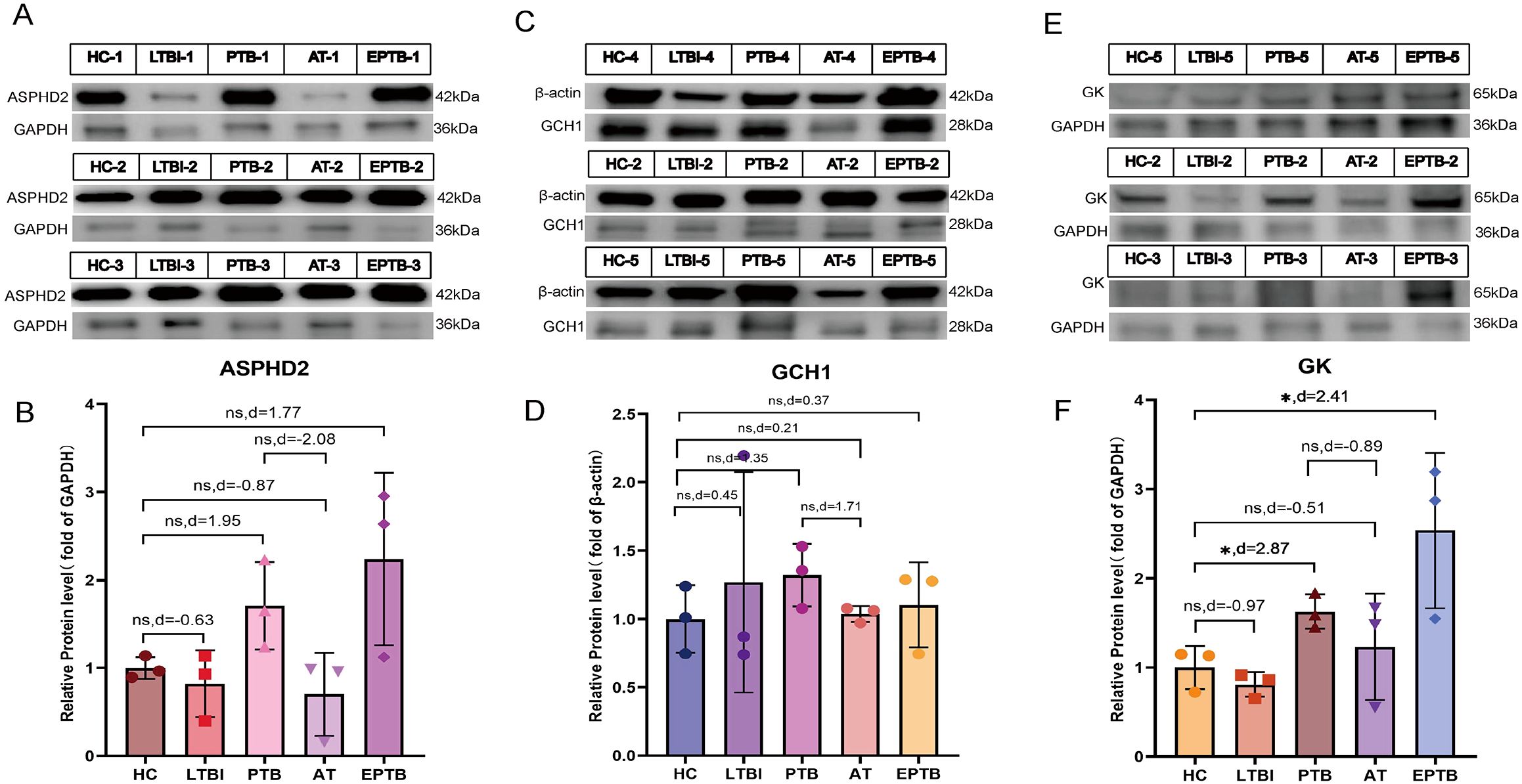 Western blot and bar graph analysis of protein expression levels for ASPHD2, GCH1, and GK across different groups: Healthy Control (HC), Latent Tuberculosis Infection (LTBI), Pulmonary Tuberculosis (PTB), Acute Tuberculosis (AT), and Extrapulmonary Tuberculosis (EPTB). Panels A, C, and E show protein bands, while B, D, and F present bar graphs with statistical annotations indicating relative protein expression levels normalized to GAPDH or β-actin. Error bars and statistical significance indicators are included.