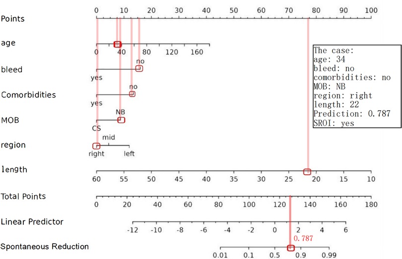 Nomogram predicting spontaneous reduction. Inputs include age, bleed status, comorbidities, MOB type, region, and length. A 34-year-old with no bleed, no comorbidities, NB type, right region, and length of 22 is predicted with a value of 0.787 and SROI as yes.