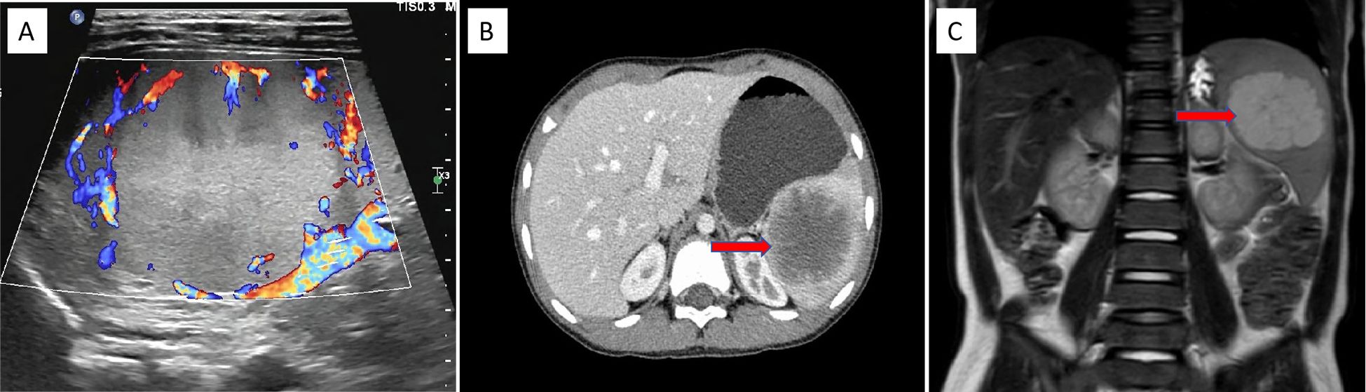 A composite medical image with three panels. Panel A: Ultrasound with Doppler showing colorful blood flow patterns in an organ. Panel B: CT scan of the abdomen displaying a large circular lesion in the liver with a red arrow indicating its presence. Panel C: MRI scan of the abdomen highlighting the same liver lesion with another red arrow for emphasis.