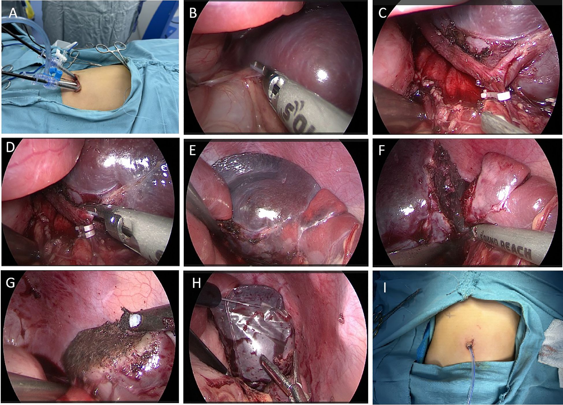 Nine surgical images showing different stages of a medical procedure. The top left and bottom right images show a patient's abdomen with surgical instruments. The other images depict various stages of internal surgery, showcasing laparoscopic views of organs, tissues, and instruments handling or removing tissue. The images capture detailed visualizations of the procedure, highlighting precision and surgical technique.