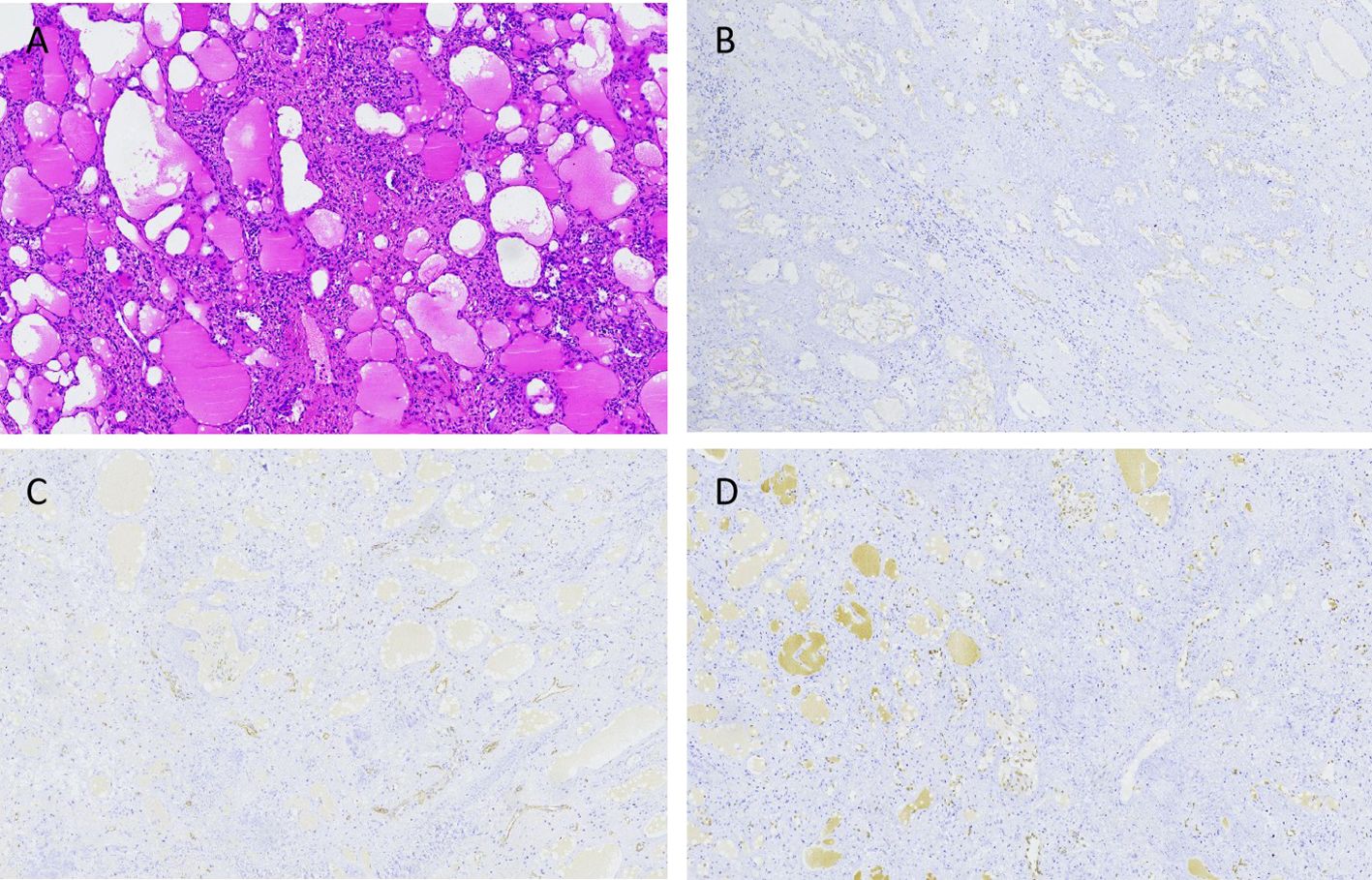 Four-panel image showing different histological slides of tissue samples. Panel A displays a vibrant pink and purple stained sample with various cell structures. Panels B, C, and D show lighter stained samples with varying degrees of speckled patterns and lighter cell formations. Each panel is labeled with letters A to D.