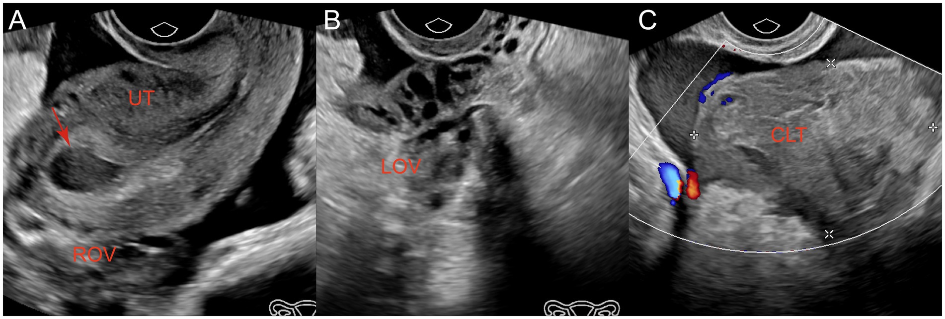 Ultrasound images showing uterine and pelvic effusion. Panel A displays uterine effusion with a red arrow and pelvic effusion, but no gestational sac. Panel B shows the left ovary with no abnormalities. Panel C highlights a hyperechoic blood clot with surrounding effusion.