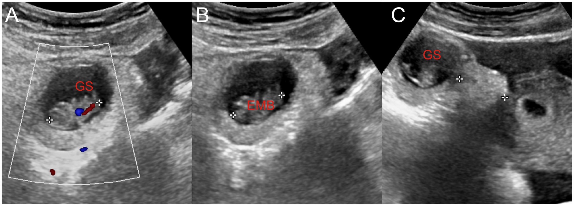 Ultrasound images of gestational sac and embryo. Panel A shows the embryo and primitive cardiac tube pulsation. Panel B indicates the embryo length (2.1 cm). Panel C displays the gestational sac 2.3 cm from the uterus with uterine and pelvic effusion.