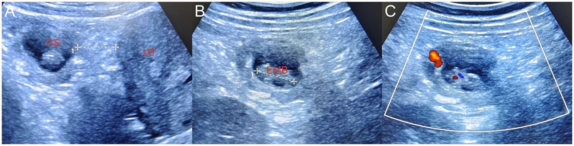 Laparoscopy and ultrasound findings. Panel A shows a primary omentum pregnancy with the gestational sac 2.5 cm from the uterus. Panel B indicates the embryo length. Panel C displays the primitive cardiac tube pulsation with no surrounding effusion.