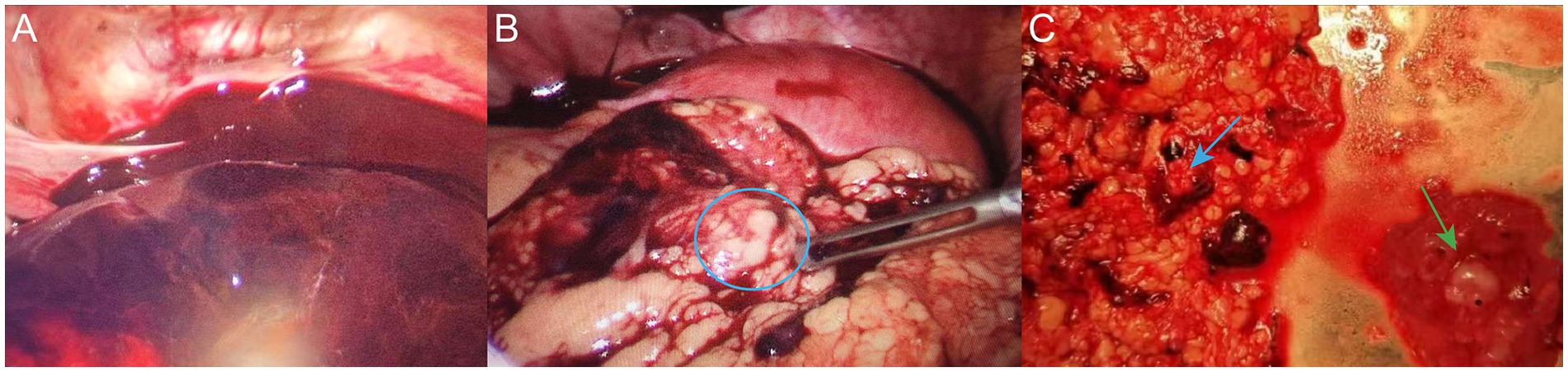 Intraoperative findings. Panel A shows dark red blood and blood clots in the abdominal and pelvic cavities. Panel B highlights embryonic tissue on the omentum. Panel C displays resected embryonic tissue and partial omentum tissue.