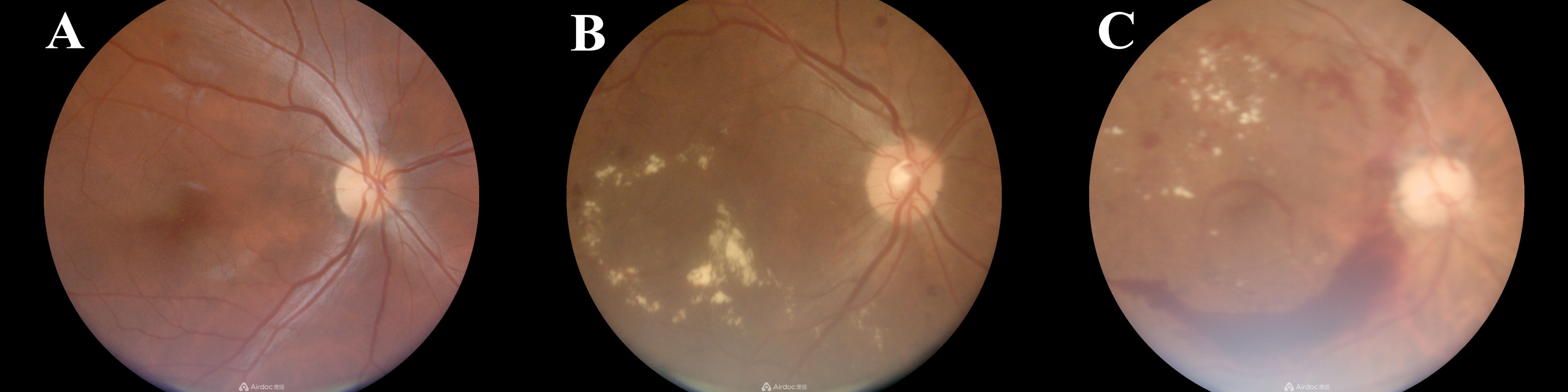 Three retinal images labeled A, B, and C. Image A shows a normal retina with distinct blood vessels. Image B displays retinal changes with pale spots indicating possible abnormalities. Image C shows more pronounced pale areas, suggesting increased severity.