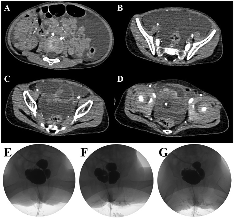 Radiographic and ultrasound images labeled A to G. Panels A to D show radiographic images of a bladder with contrasting dye highlighting its structure. Panels E to G display ultrasound images of the bladder in video urodynamics, depicting its varying shapes and sizes. Each panel provides different diagnostic views for medical assessment.