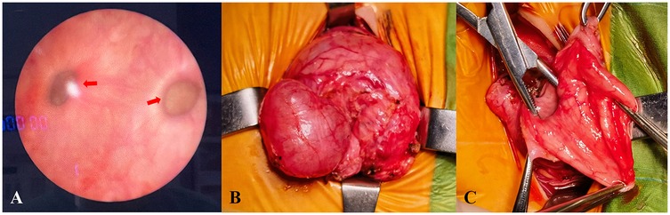 A three-panel medical image showing:\n\n(A) An endoscopic view of the bladder with two arrow-marked lesions, likely bladder diverticulitis. \n(B) An open surgical view of a large, irregular diverticula, with surrounding tissue.\n(C) A close-up of excised tissue held by surgical clamps, displaying a smooth, pink surface.