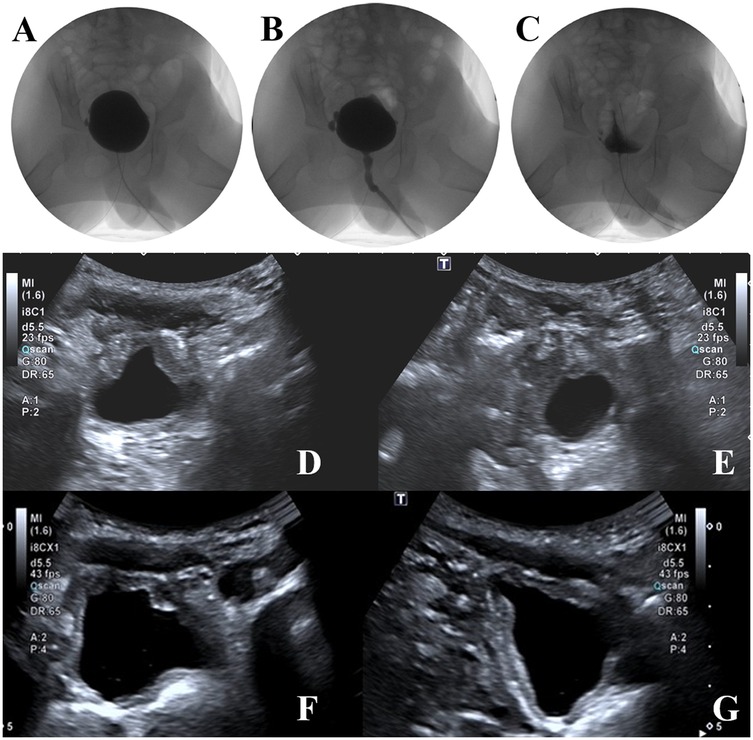 CT scan panels A to C show axial views of the abdomen and pelvis, highlighting different anatomical sections. Panels D to G are radiographic images displaying a cluster of dark shapes, likely representing a contrast study of pelvic organs.