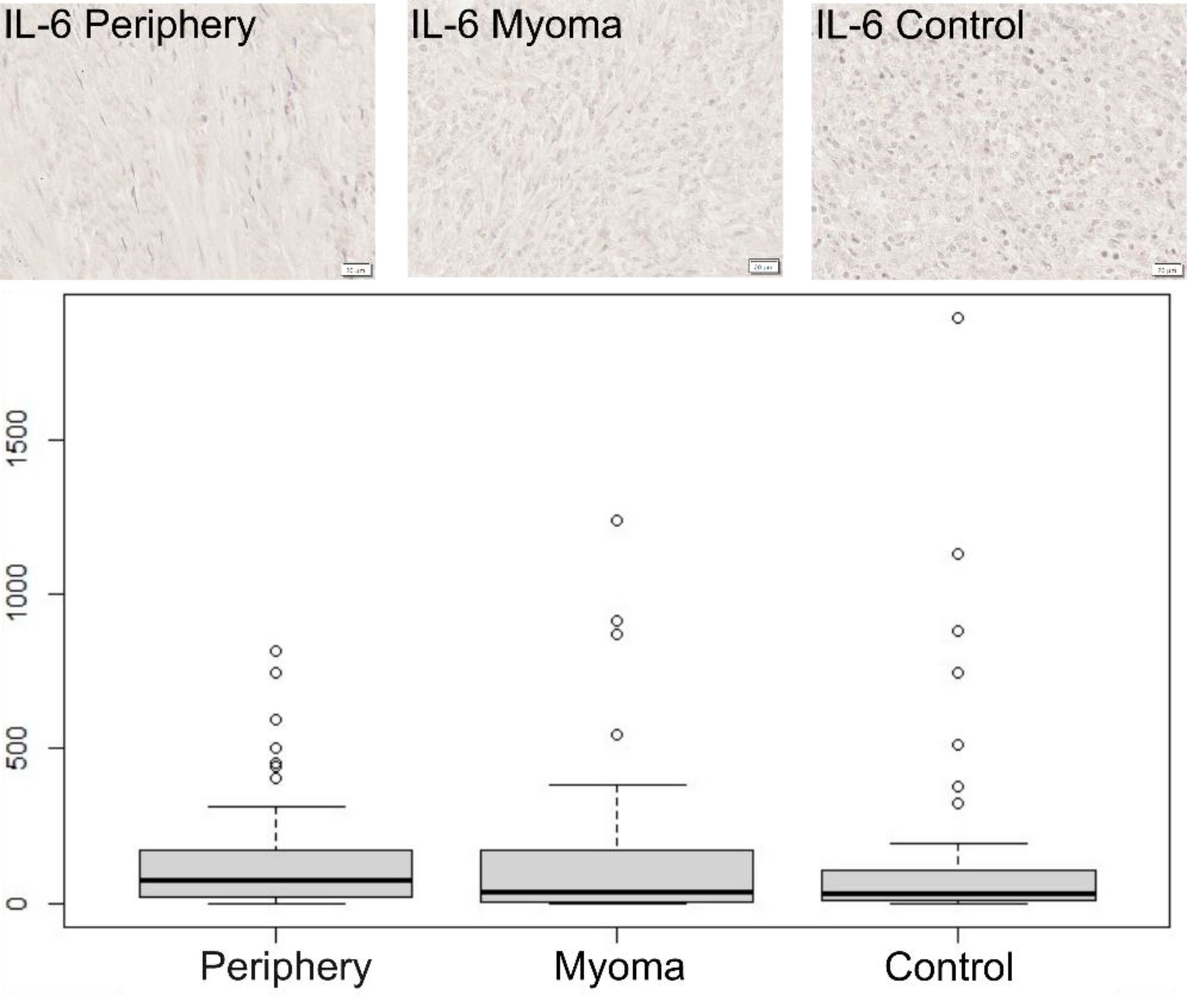 Three microscopic images show IL-6 staining in different tissue types: Periphery, Myoma, and Control, each with a scale bar of 20 micrometers. Below, a box plot compares IL-6 expression levels across Periphery, Myoma, and Control, with outliers marked as individual points above each box.