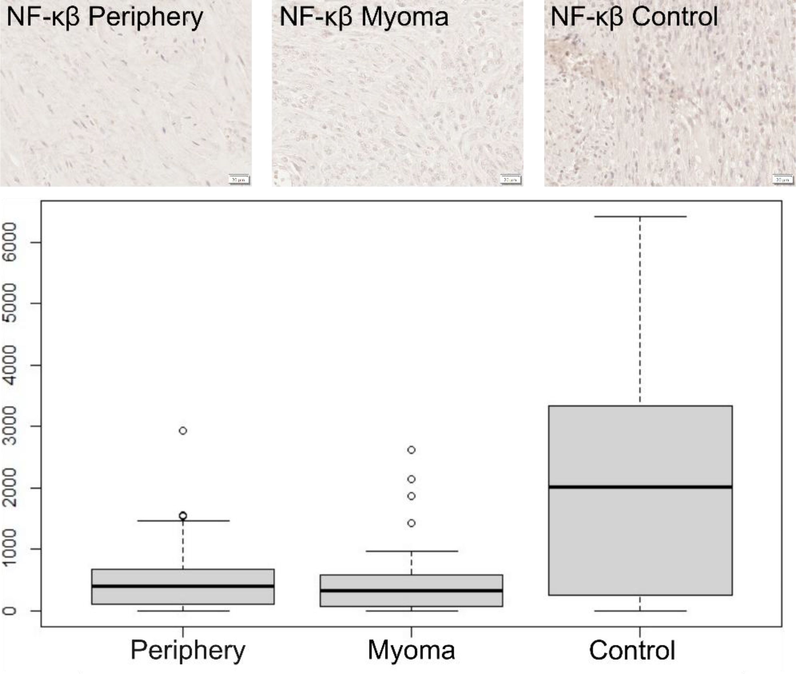 Three microscopic images labeled “NF-κβ Periphery,” “NF-κβ Myoma,” and “NF-κβ Control” display tissue samples with varying staining intensities. Below, a box plot compares staining intensities for Periphery, Myoma, and Control groups, showing highest median intensity in the Control group.