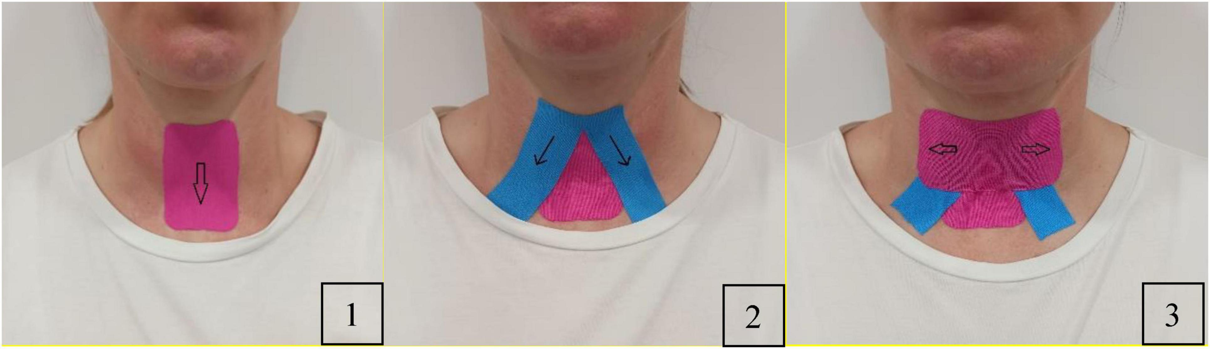 Close-up images showing three taping techniques on a person’s neck. Image 1 displays a pink tape with a downward arrow. Image 2 shows pink tape with blue strips angled downwards. Image 3 features pink tape with crossed blue strips at the sides.