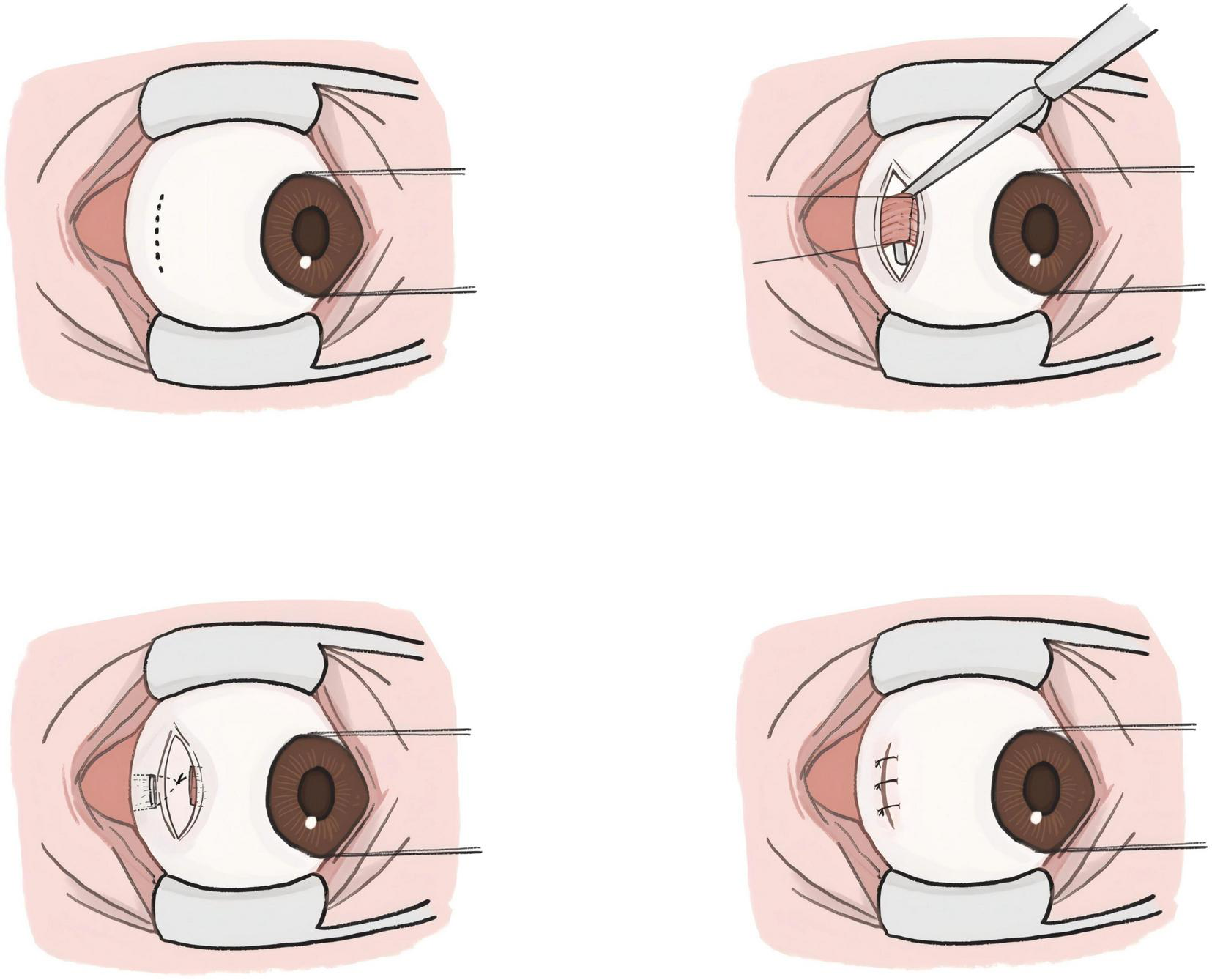 Illustration depicting a series of four steps in the modified Swan incision (MSI) procedure combined with lateral rectus muscle suspension and recession.