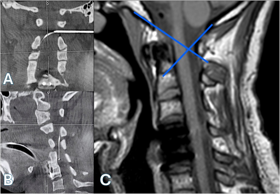 Three medical imaging panels of the cervical spine. Panel A shows a coronal CT scan with a needle entering laterally toward the midline of the upper cervical vertebrae. Panel B displays a sagittal CT scan showing the full trajectory of the needle from anterior soft tissue to the cervical vertebral body, likely indicating targeted intervention or biopsy. Panel C presents a sagittal MRI of the cervical spine with a superimposed blue X mark over the spinal canal and vertebral bodies, highlighting a region of interest at the C2–C3 level, possibly indicating pathology or a planned intervention site.