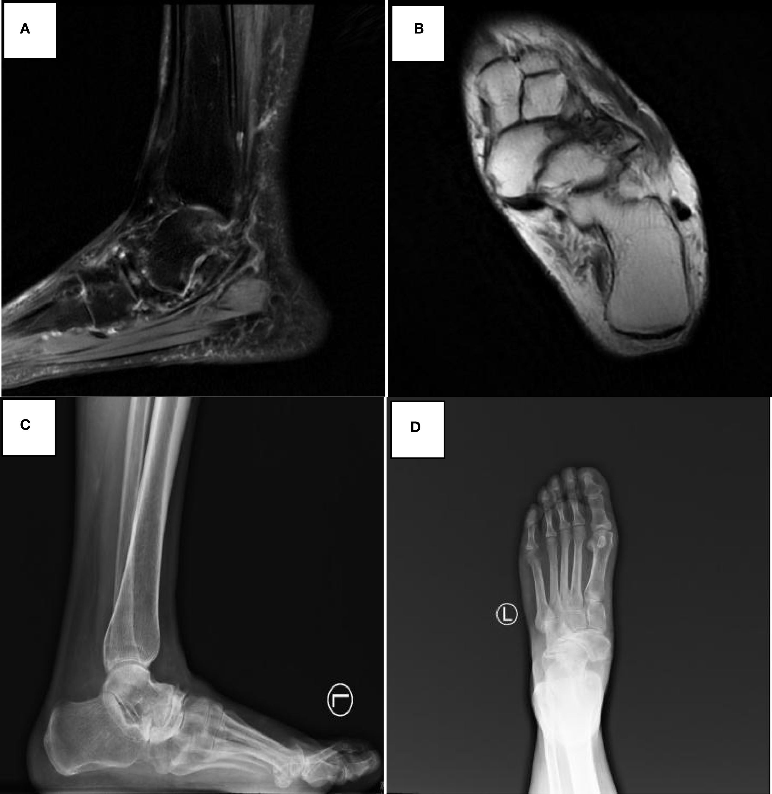 Panel of four images showing MRI and X-ray scans of a foot and ankle. A: Side view MRI showing anatomical structures of the foot and ankle. B: MRI cross section highlighting internal tissues. C: Side view X-ray of the ankle and foot bones. D: Top view X-ray of the left foot bones.
