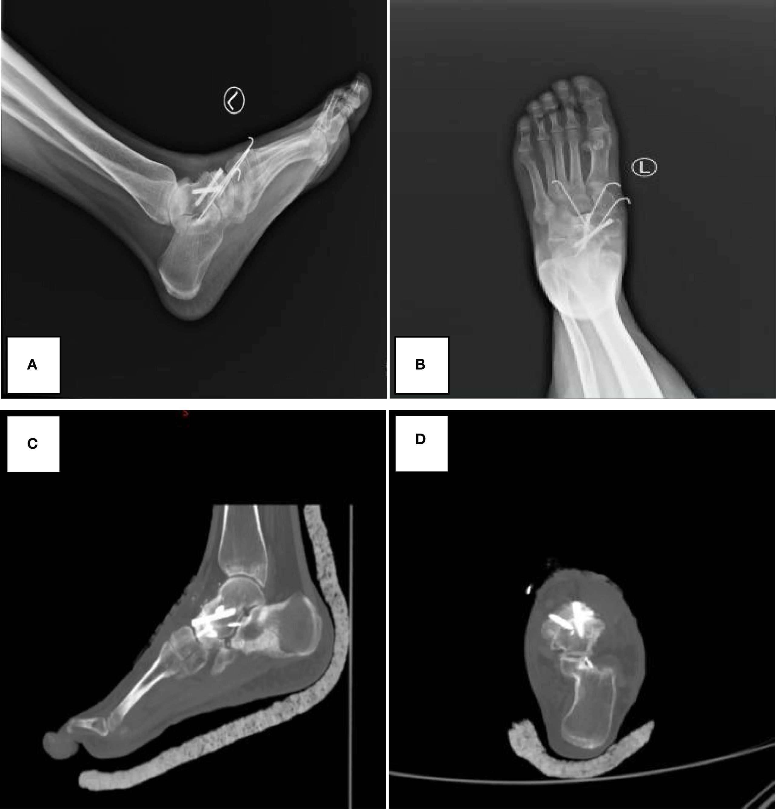 X-ray and CT images of a foot with fixation hardware. Panel A shows a lateral X-ray view, Panel B displays a top-down X-ray view, Panel C presents a CT side view, and Panel D shows a CT cross-sectional view. The images highlight the metal fixation devices used in the foot.