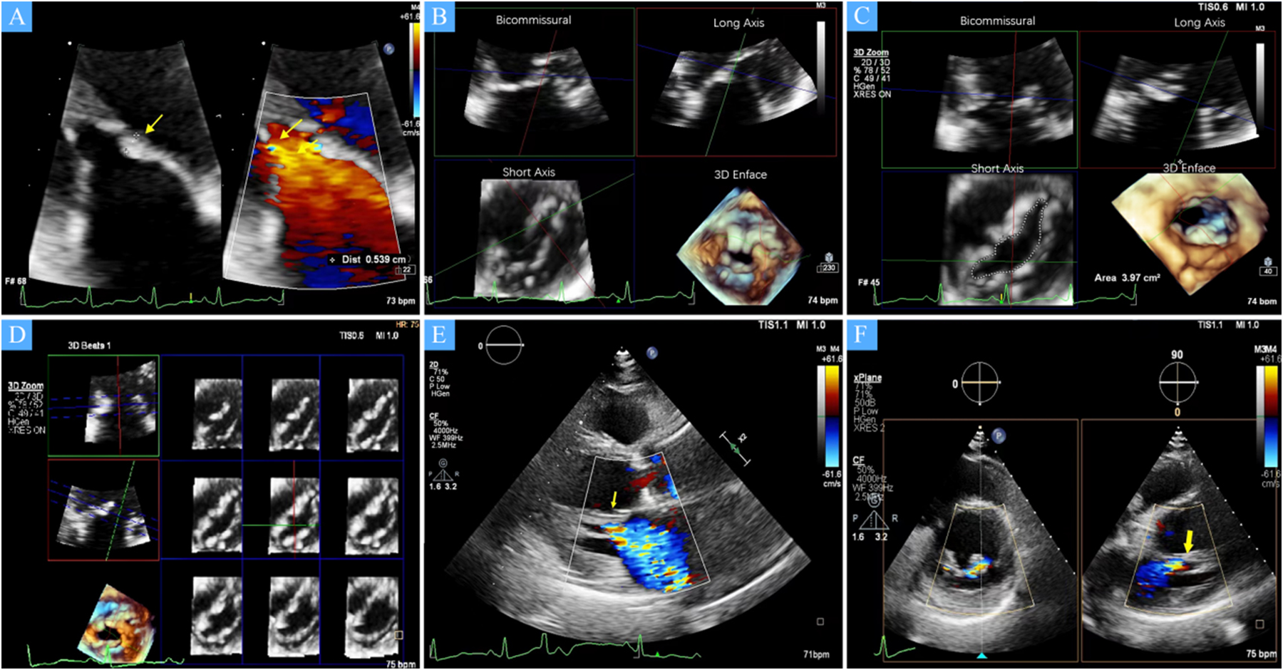 A set of six ultrasound images labeled A to F, depicting cardiac structures. Image A shows Doppler ultrasound with color flow, highlighting blood flow with a yellow arrow. Images B and C display biplanar and three-dimensional views of heart anatomy, including bicommissural, long axis, short axis, and 3D enface views. Image D presents multiple sequential frames of a cardiac cycle. Image E shows another Doppler ultrasound with detailed blood flow visualization. Image F includes two xPlane images with color Doppler showing highlighted flow, marked by yellow arrows. Each image features measurements and heart rates.