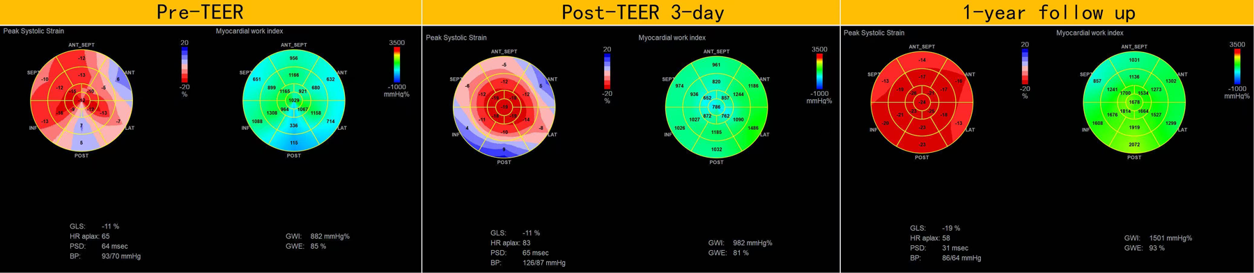Three panels show cardiac assessment data at different stages: Pre-TEER, Post-TEER 3-day, and 1-year follow-up. Each panel presents two circular diagrams: \"Peak Systolic Strain\" and \"Myocardial Work Index,\" with color gradients indicating varying levels. The Pre-TEER GLS is -11%, Post-TEER 3-day is -11%, and 1-year follow-up is -19%. Measurements include heart rate, blood pressure, and myocardial work metrics. The data reflect changes over time, with notable shifts in strain and work indices.