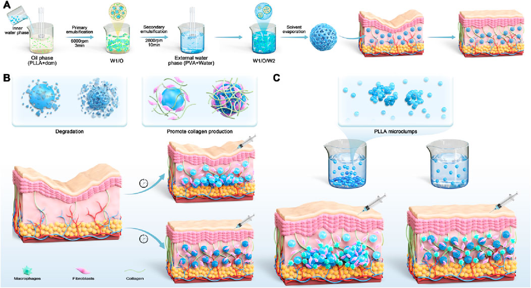 Diagram illustrating the synthesis and application of PLLA microcapsules. Section A shows the emulsion process for creating microcapsules using oil and water phases. Section B depicts degradation and collagen production stages with images of skin layers and cell interactions, including macrophages and fibroblasts. Section C highlights PLLA microclumps for skin application, showing delivery via syringe and the resulting skin structure improvements.
