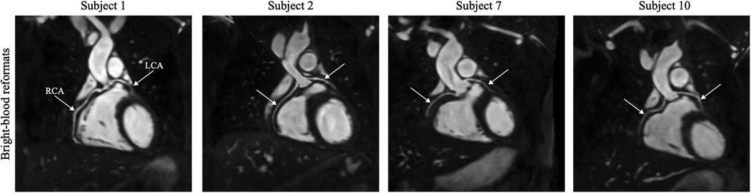 Four medical images labeled Subject 1, Subject 2, Subject 7, and Subject 10, showing bright-blood reformats of the heart. Arrows point to highlighted areas, with labels “RCA” (Right Coronary Artery) and “LCA” (Left Coronary Artery) on Subject 1.
