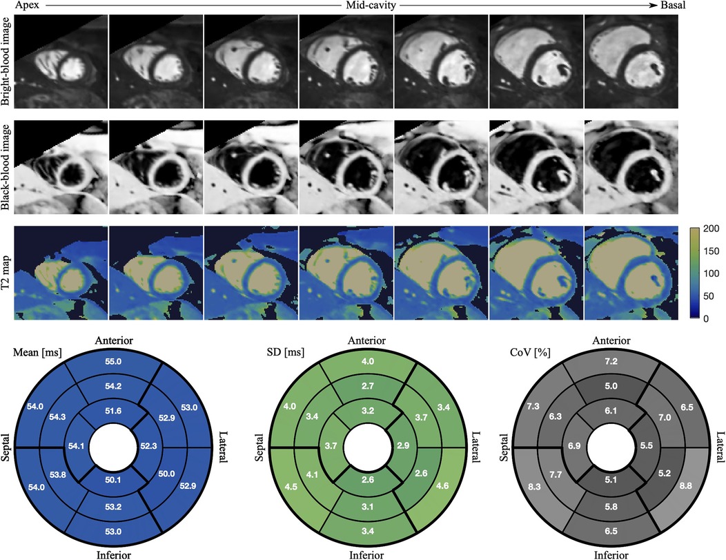 Cardiac MRI images displaying bright-blood and black-blood imaging sequences, alongside T2 maps, labeled as apex, mid-cavity, and basal. Below, three bullseye diagrams detail myocardial T2 relaxation parameters: mean, standard deviation, and coefficient of variation, with color-coded segments for anterior, lateral, septal, and inferior regions.