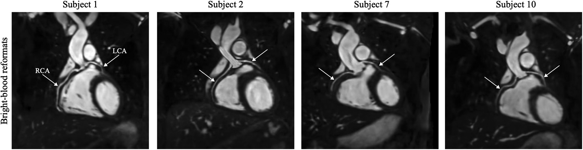 Four medical images labeled Subject 1, Subject 2, Subject 7, and Subject 10, showing bright-blood reformats of the heart. Arrows point to highlighted areas, with labels “RCA” (Right Coronary Artery) and “LCA” (Left Coronary Artery) on Subject 1.