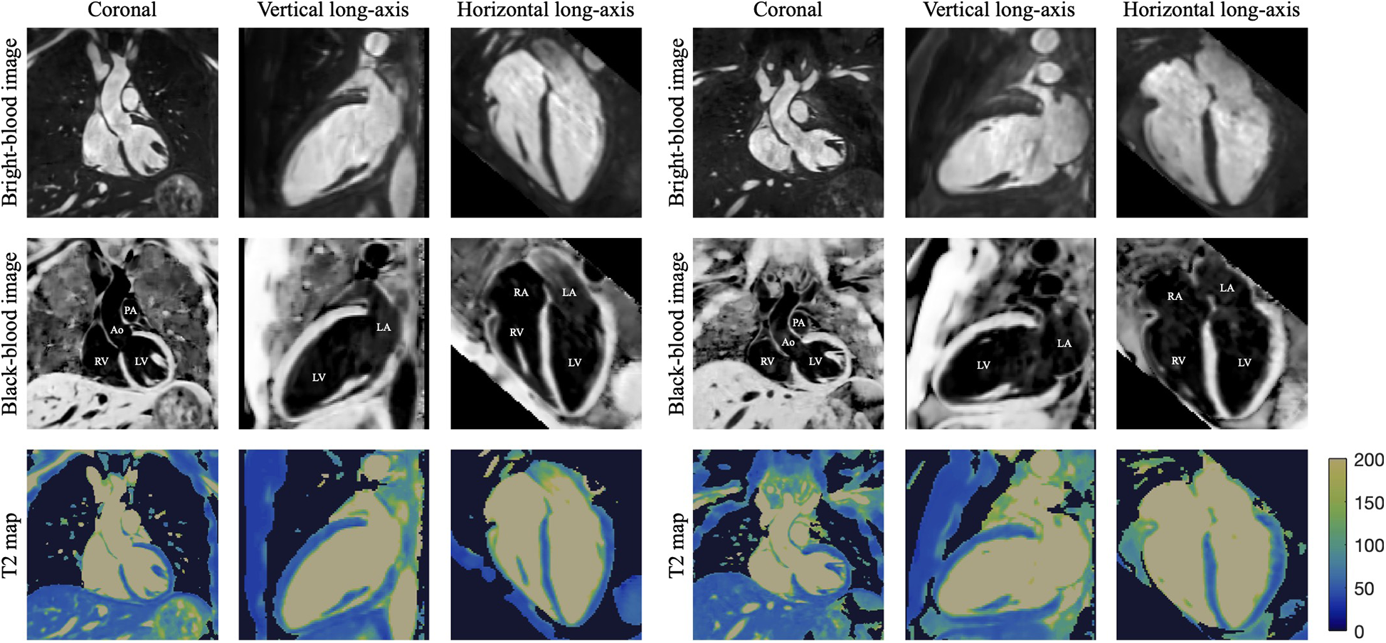 Series of medical images showing bright-blood, black-blood, and T2 map images of the heart in coronal, vertical long-axis, and horizontal long-axis views. Labels indicate heart structures like the left ventricle (LV), right ventricle (RV), left atrium (LA), right atrium (RA), pulmonary artery (PA), and aorta (Ao). The T2 maps use a color scale ranging from blue to yellow to indicate varying intensities.