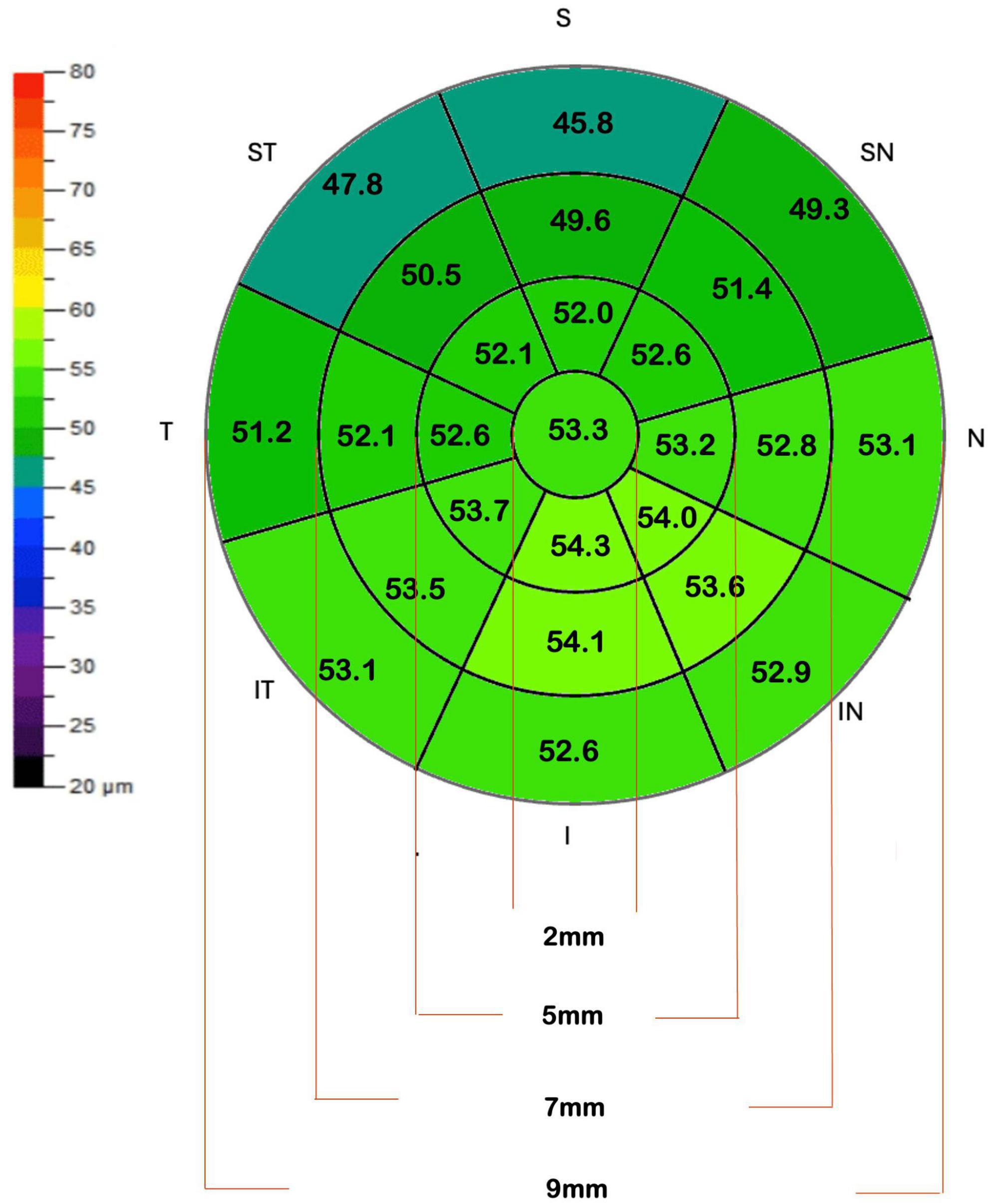 Circular diagram showing corneal thickness measurements in micrometers, divided into nine sectors with values ranging from 47.8 to 54.3. A color gradient from blue to red indicates thickness, with the center displaying the thickest areas. A vertical scale on the left shows thickness values from 20 to 80 micrometers.