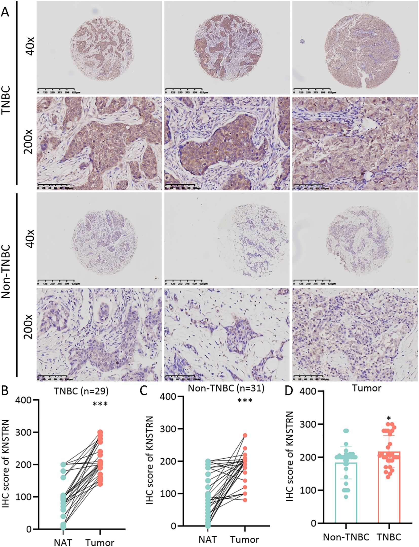 Panel A shows four sections of tissue samples stained for KNSTRN at magnifications of 40x and 200x, comparing TNBC and non-TNBC samples. Panels B and C depict the IHC scores of KNSTRN for TNBC and non-TNBC groups, respectively, illustrating higher scores in tumor tissues compared to NAT. Panel D compares IHC scores between TNBC and non-TNBC tumors, showing significant differences.
