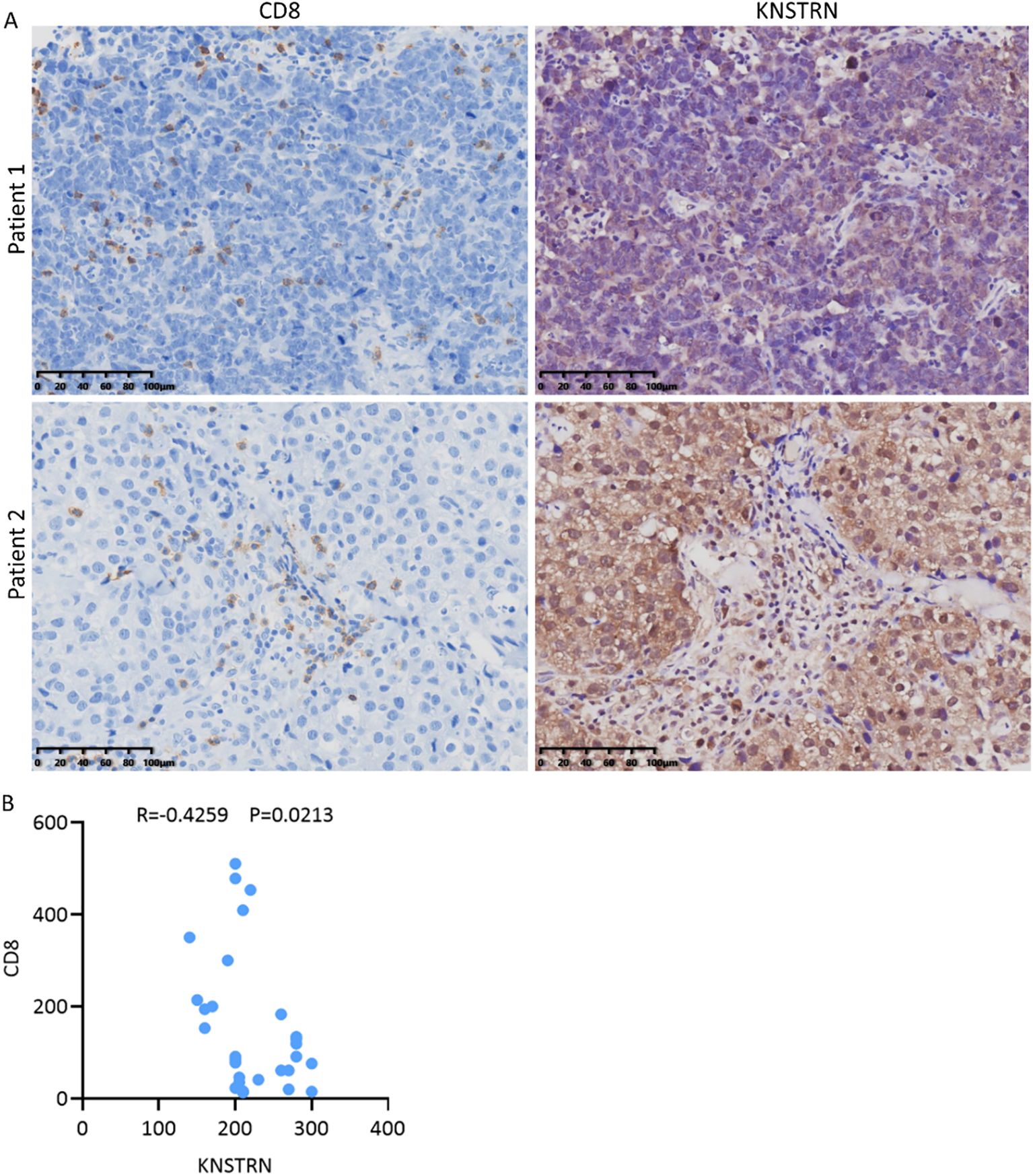 Two panel immunohistochemistry images and a scatter plot. Panel A shows tissue samples of two patients with staining for CD8 (left) and KNSTRN (right). Patient 1 shows more CD8 presence compared to Patient 2. Panel B contains a scatter plot displaying a negative correlation between KNSTRN and CD8 levels, with R equal to negative 0.4259 and a p-value of 0.0213.