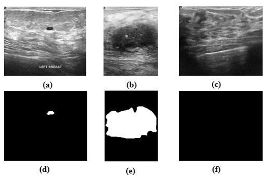 A composite image showing ultrasound scans and corresponding ground truth masks. (a–c) depict breast ultrasound images with different lesion characteristics. (d–f) show the corresponding binary masks: white regions represent lesions and black indicates the background. Image (f) has no detected lesion, indicating a normal case.