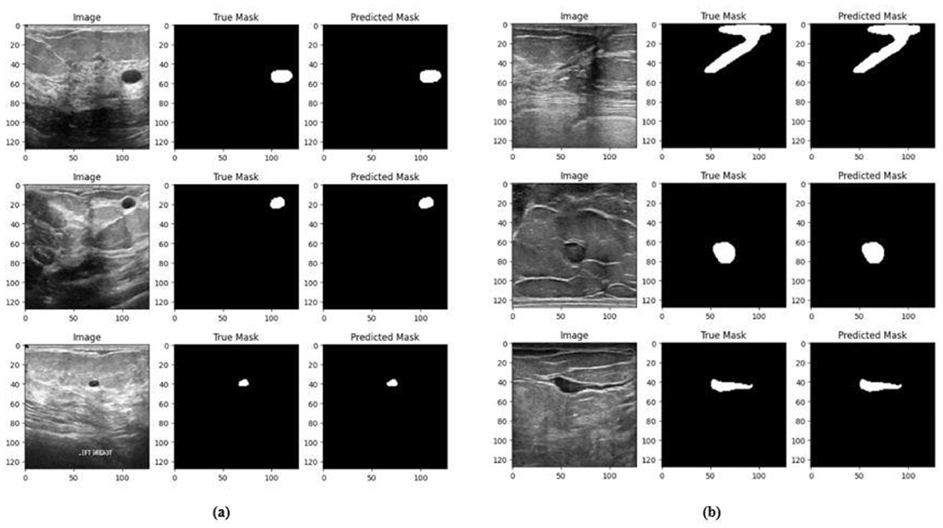 Three rows of breast ultrasound images with corresponding segmentation masks. Each row shows an original grayscale ultrasound (left), the true tumor mask (middle), and the predicted mask (right). Tumor areas are marked in white on black backgrounds. The predicted masks align well with the true masks, demonstrating high segmentation accuracy.