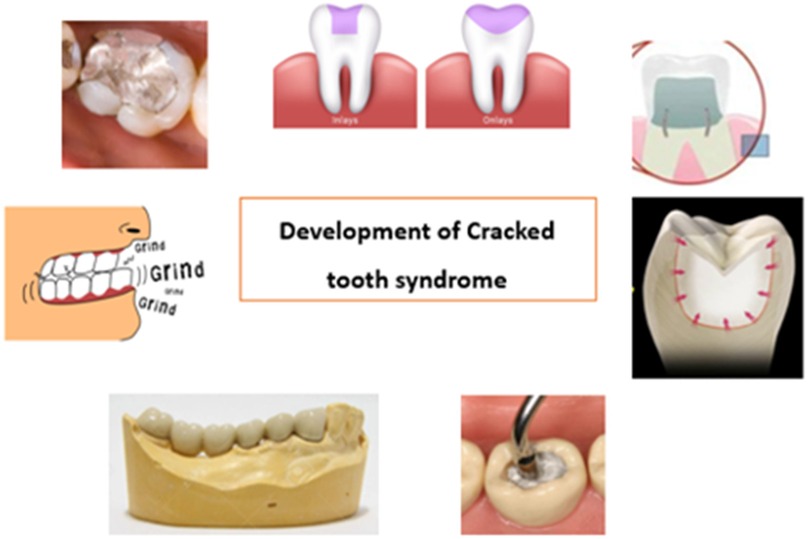 Illustration depicting various stages and causes of cracked tooth syndrome. Includes images of tooth inlays and onlays, dental grinding, and dental tools on a tooth. Central text reads, \