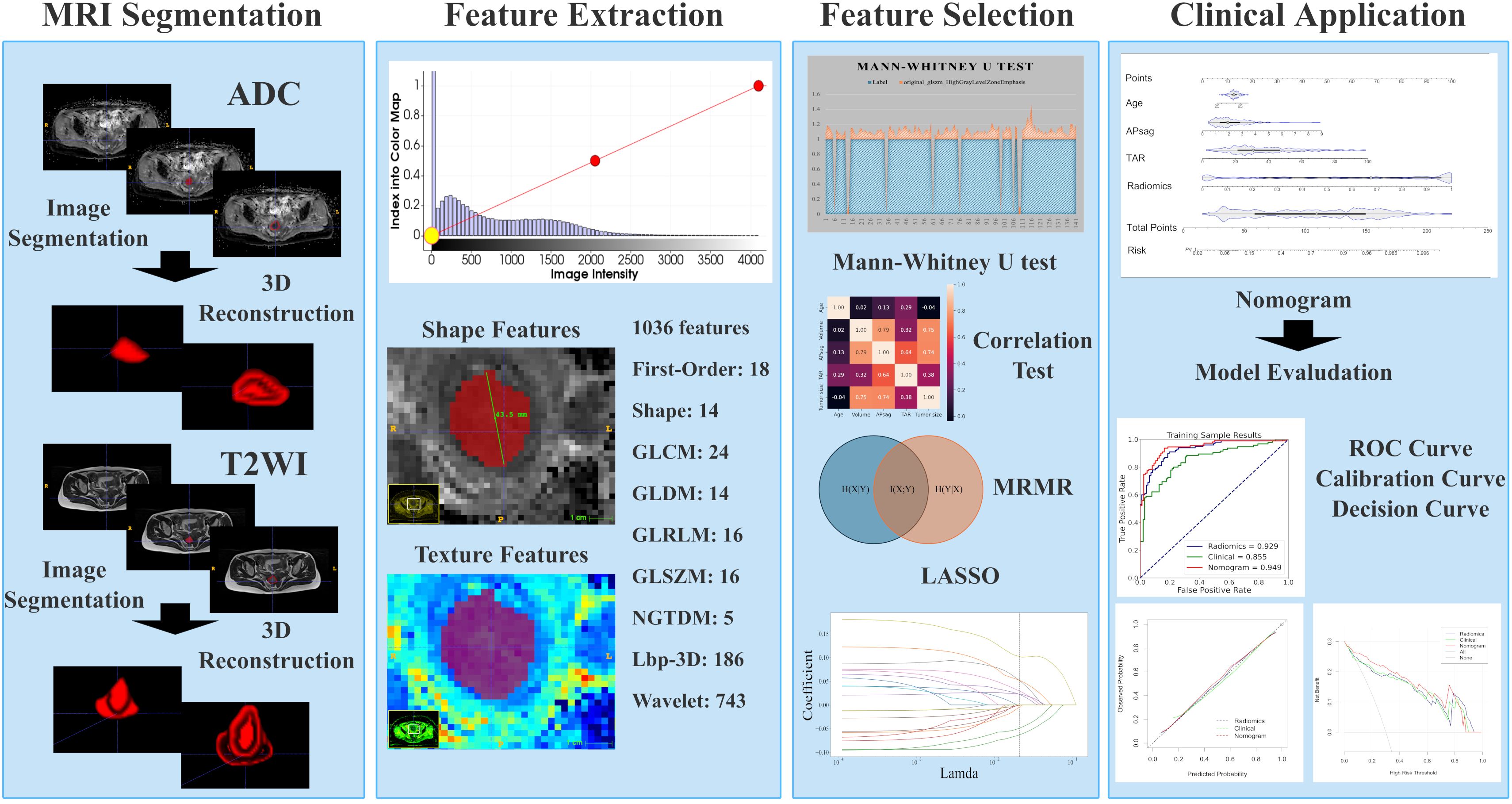 A flowchart depicts a medical image analysis process split into four sections: MRI Segmentation, Feature Extraction, Feature Selection, and Clinical Application. In MRI Segmentation, images undergo segmentation and 3D reconstruction for ADC and T2WI. Feature Extraction shows graph plots and lists 1036 features, including shape and texture. Feature Selection includes a Mann-Whitney U test, correlation tests, and feature selection through MRMR and LASSO methods. Clinical Application features a nomogram for model evaluation and displays ROC, calibration, and decision curves. Each section visually represents corresponding steps with diagrams and text.