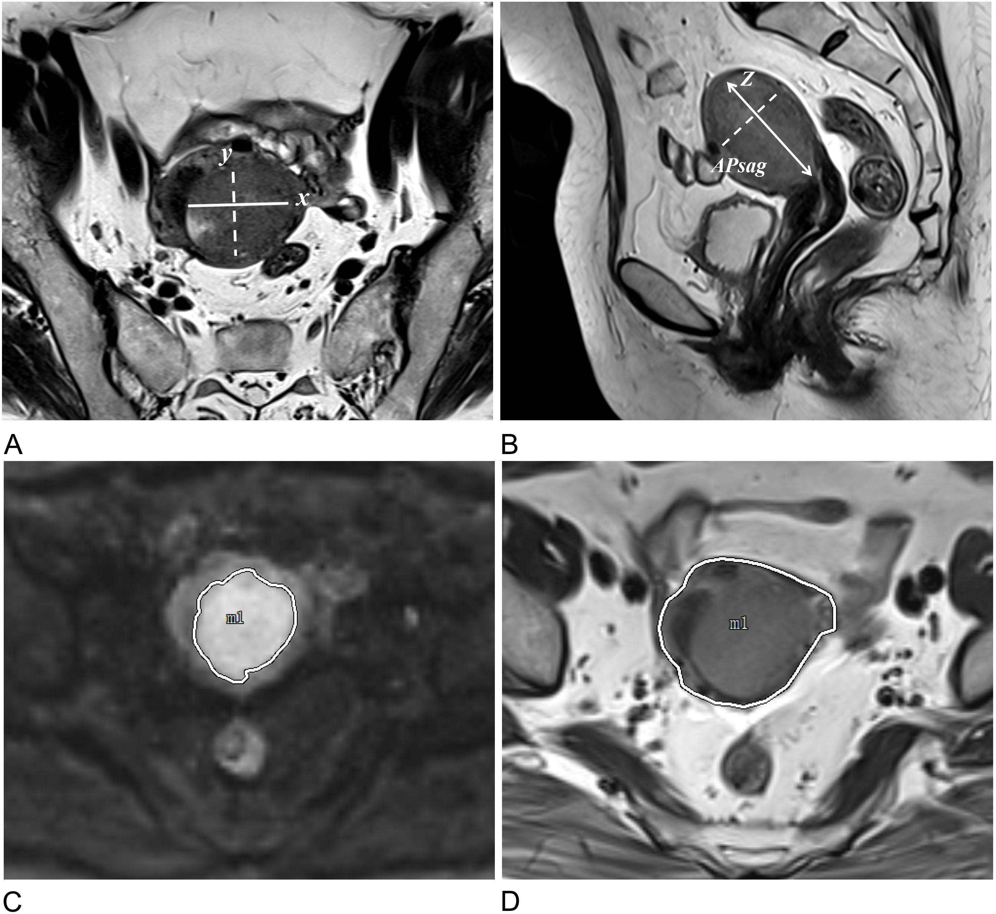 MRI images demonstrate the measurement methods of tumor morphological parameters. Image A is an oblique axial view, labeled with the x-axis and y-axis. Image B is a sagittal view, labeled with the z-axis and APsag. Images C and D outline the maximum cross-sectional areas of the tumor and uterus in the axial view.