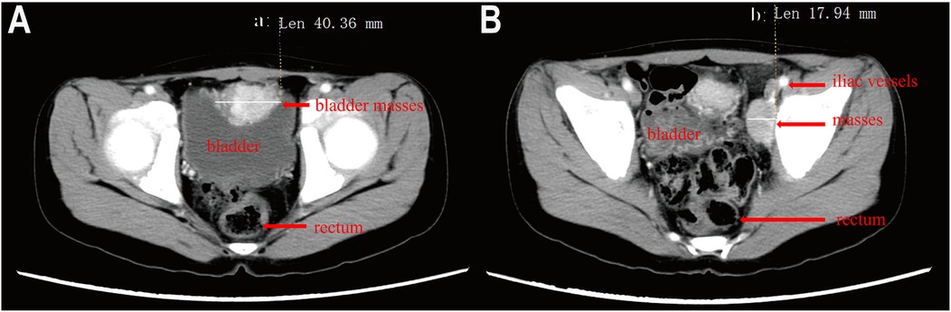 CT scan images labeled as A and B showing transverse sections of the pelvic region. Image A displays the bladder, bladder masses, and rectum with a measurement of forty point thirty-six millimeters. Image B also highlights the bladder, masses, iliac vessels, and rectum with a measurement of seventeen point ninety-four millimeters.