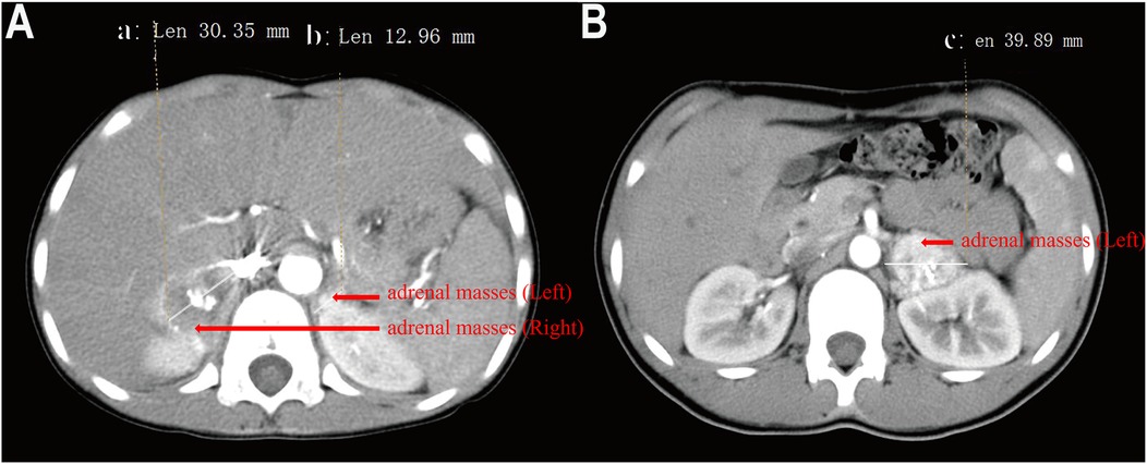 CT scan images labeled A and B showing cross-sections of the abdomen. Both images highlight adrenal masses with red arrows. Image A shows masses on the left and right, while image B shows a mass on the left with measurements indicated.